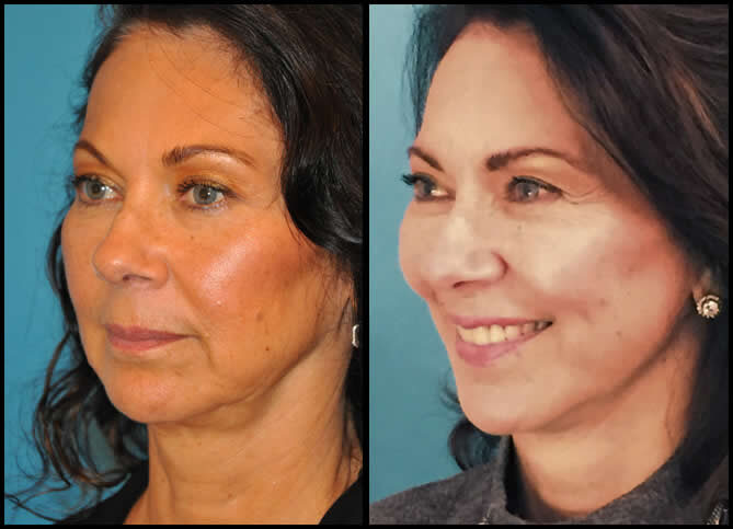 Plastic Surgery | Patient Results | Certified Plastic Surgeon in New York | Call Now 646-470-0918