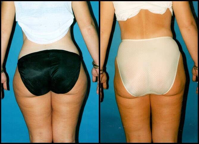 Certified Liposuction Surgeon in New York City | Call 646-470-0918 | Barry M Weintraub, MD, FACS