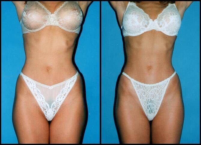 Certified Liposuction Surgeon in New York | Call 646-470-0918 | Barry M Weintraub, MD, FACS