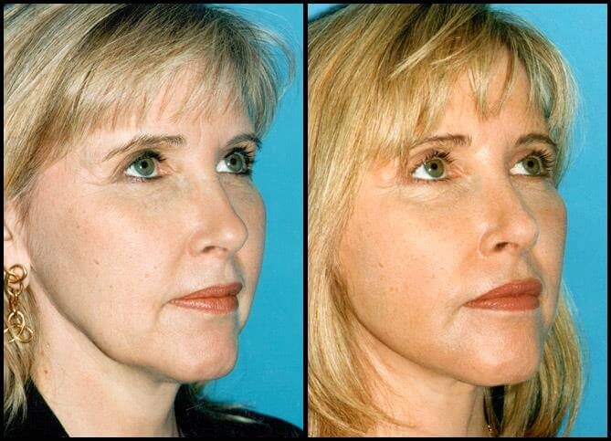 Patient Results | Board Certified Plastic Surgeon in New York | Call Now 646-470-0918 | Barry M Weintraub, MD, FACS