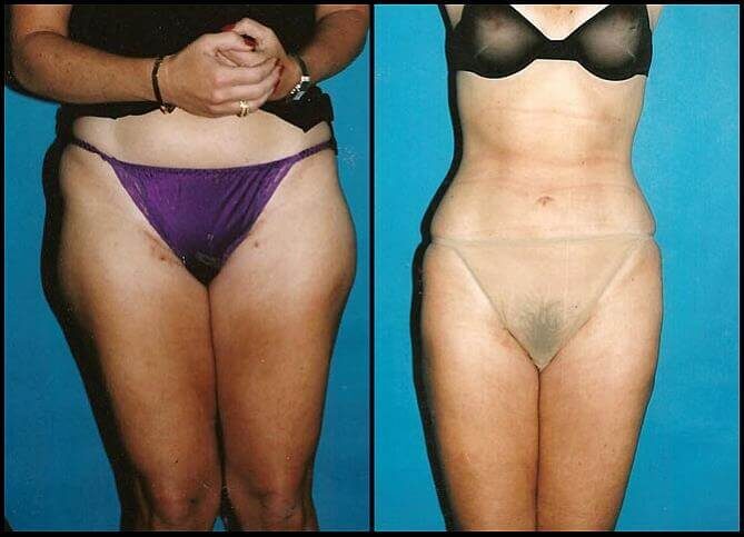 Board Certified Liposuction Surgeon in New York – Call 646-470-0918 – Barry M Weintraub, MD, FACS
