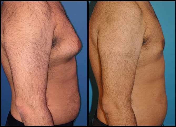 Certified Gynecomastia Rhinoplasty Surgeon in NYC | Call (646) 470-0918