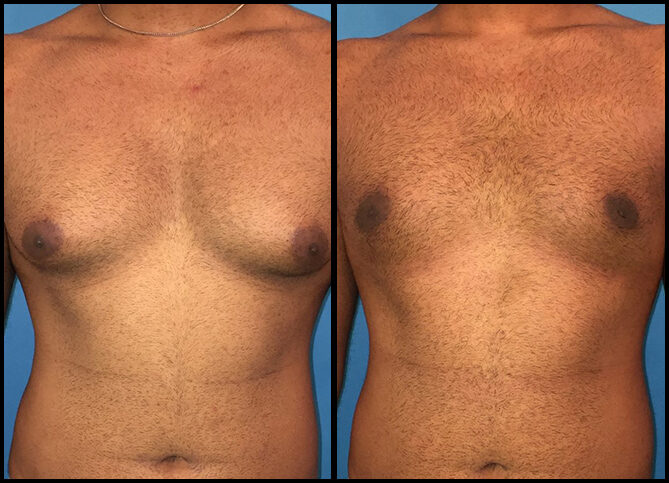 Certified Gynecomastia Rhinoplasty Surgeon in New York City | Call (646) 470-0918