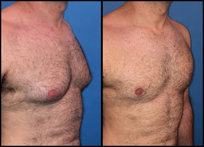 Board Certified Gynecomastia Surgeon in New York | Call 646-470-0918 | Barry M Weintraub, MD, FACS