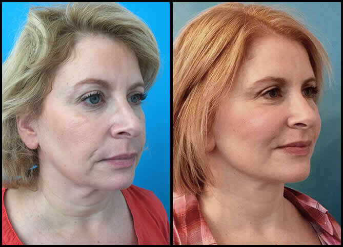 Plastic Surgery in New York | Call 646-470-0918 | Barry M Weintraub, MD, FACS