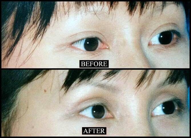 Board Certified Blepharoplasty Surgeon NYC | Call 646-470-0918 | Barry M Weintraub, MD, FACS