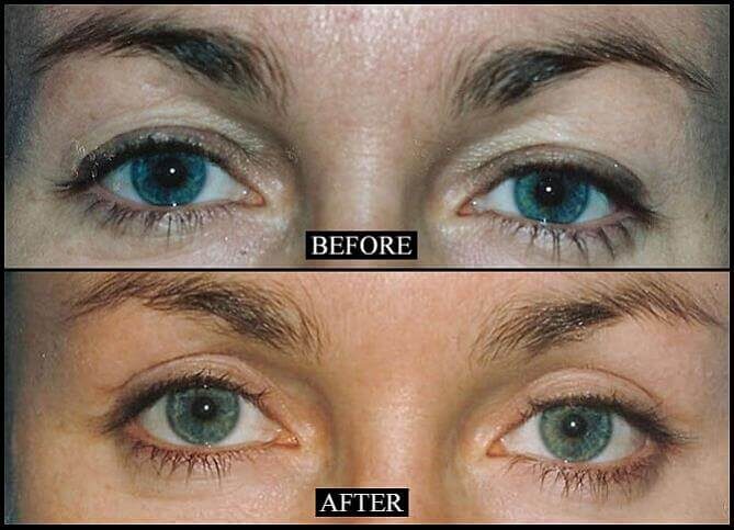 Certified Blepharoplasty Surgeon New York City | Call (646) 470-0918 | Barry M Weintraub, MD, FACS