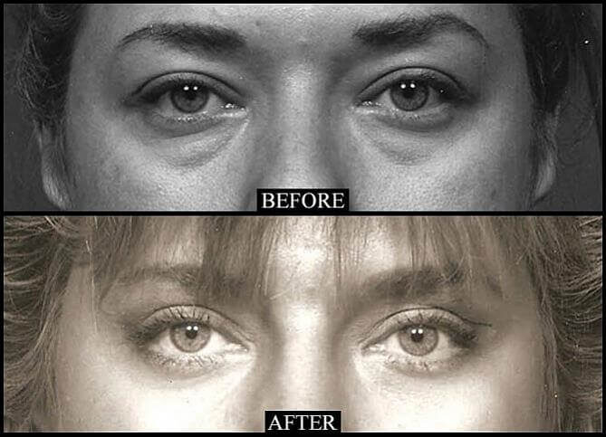 Certified Blepharoplasty Surgeon NYC | Call (646) 470-0918 | Barry M Weintraub, MD, FACS