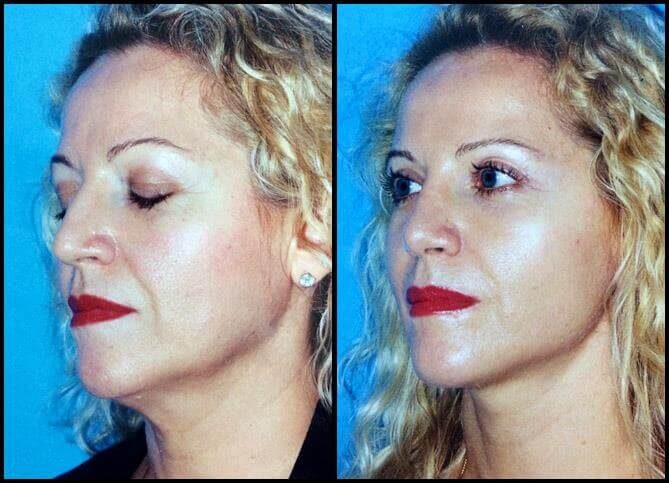 Board Certified Neck Lift Surgeon NYC | Call (646) 470-0918