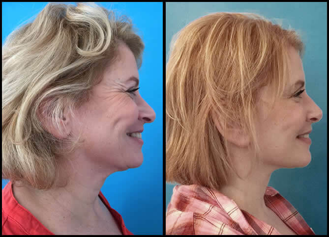 Best Neck Lift Surgeon NYC – Call (646) 470-0918