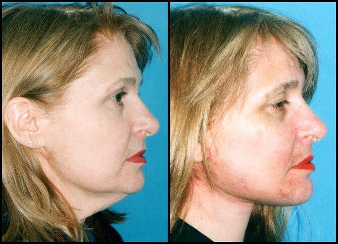 Certified Neck Lift Surgeon | New York City | Call 646-470-0918 | Barry M Weintraub, MD, FACS