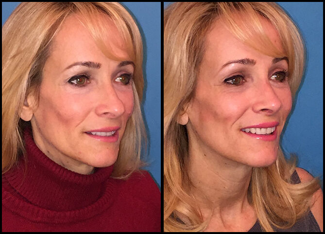 Certified Revision Rhinoplasty Surgeon in NYC | Call (646) 470-0918