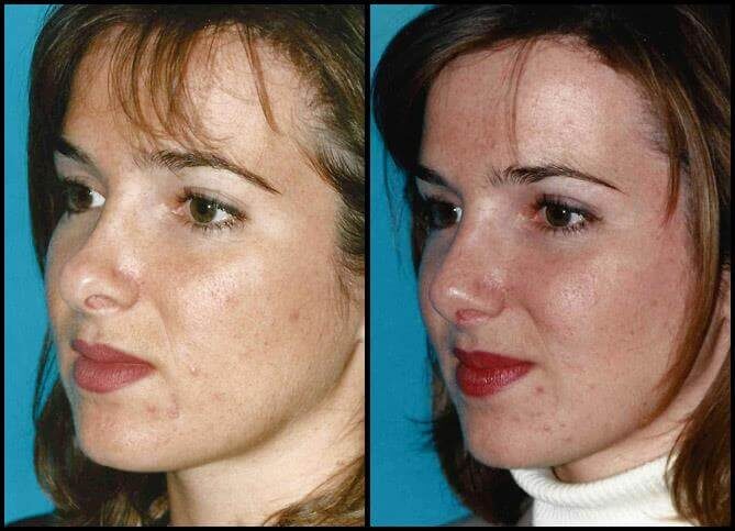 Top Aesthetic Surgeon for Rhinoplasty Revision in NYC | Call (646) 470-0918