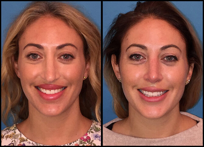 Revision Rhinoplasty Surgeon in New York City | Call (646) 470-0918
