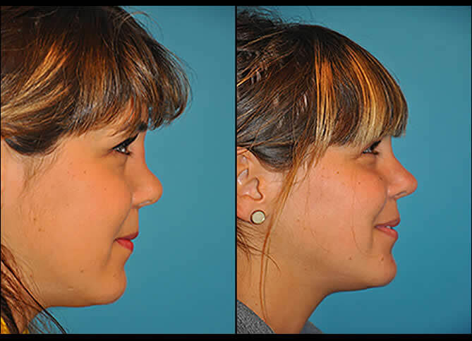 Board Certified Revision Rhinoplasty Surgeon NY - Call (646) 470-0918