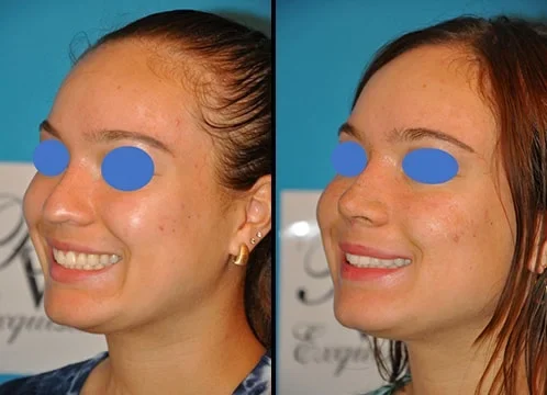 Aesthetic Rhinoplasty Surgeon in New York City | Call (646) 470-0918