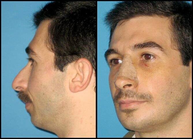 Best Teenage Rhinoplasty Surgeon NYC | Call (646) 470-0918