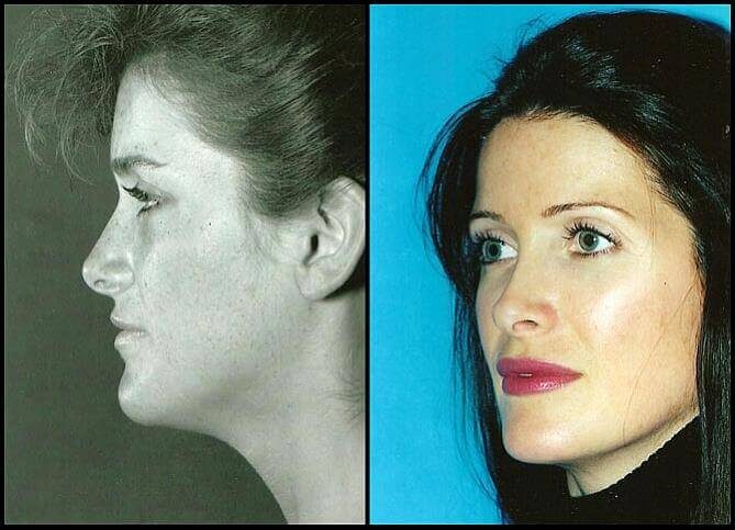 Board Certified Teenage Rhinoplasty Surgeon in New York City | Call (646) 470-0918