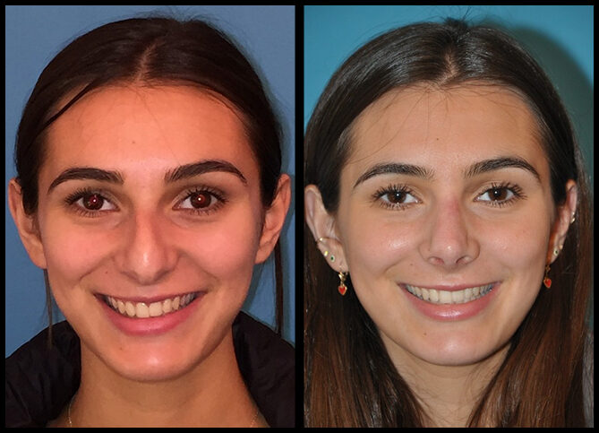Before and After
