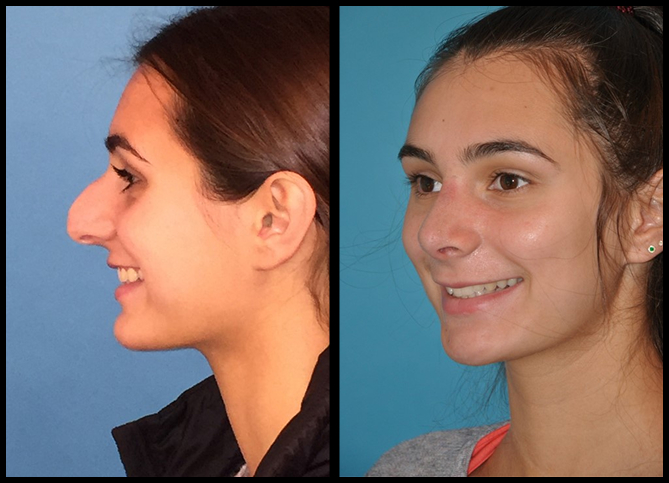 Before and After