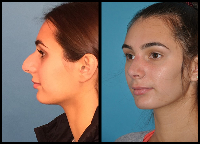 Before and After