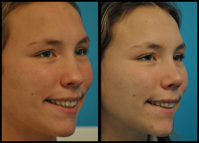 Before and After