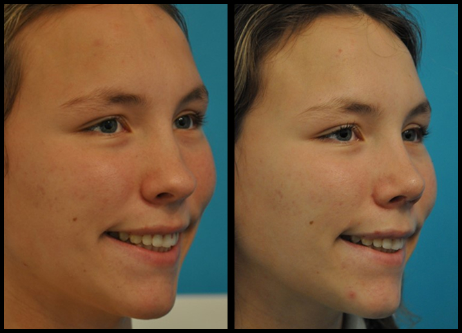 Before and After
