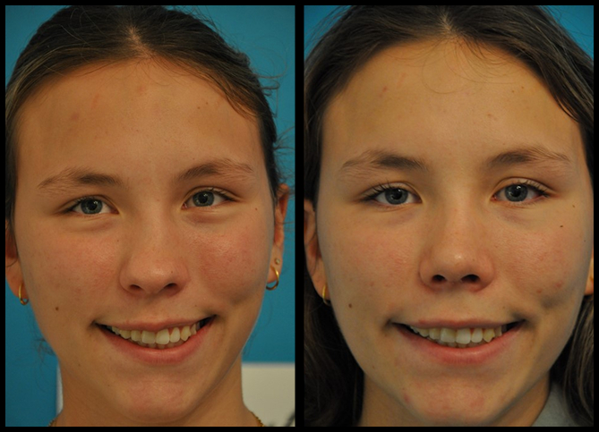 Before and After
