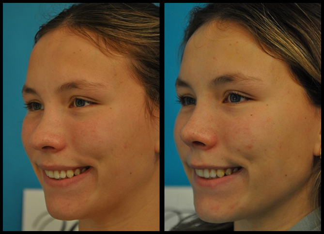 Before and After