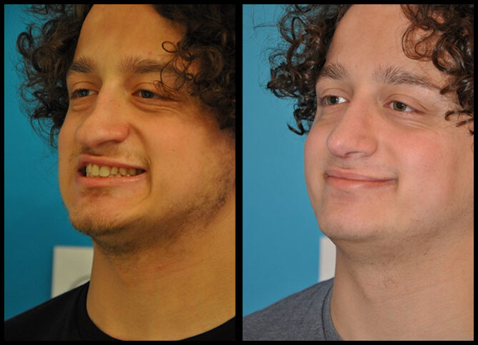 Before and After