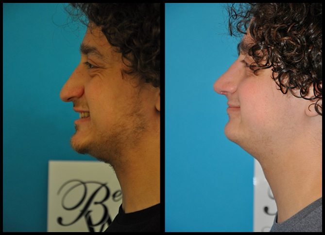 Before and After