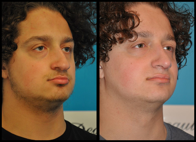 Before and After