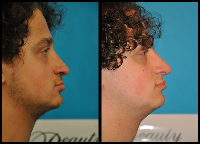 Before and After