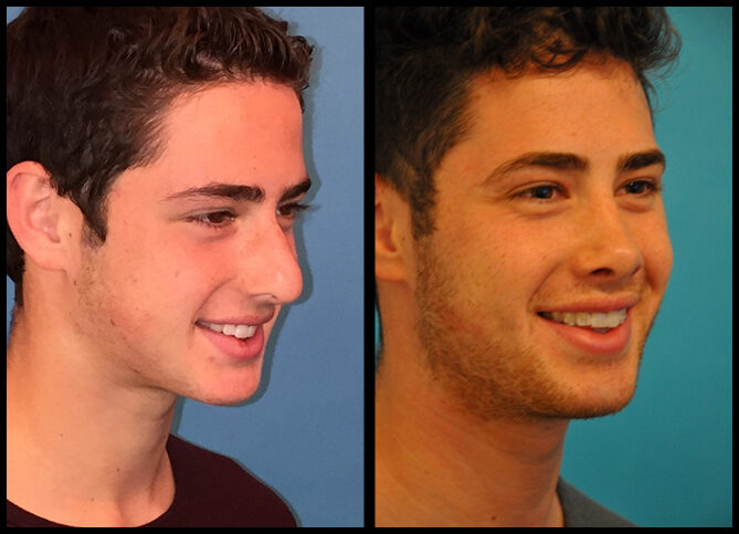 Before and After