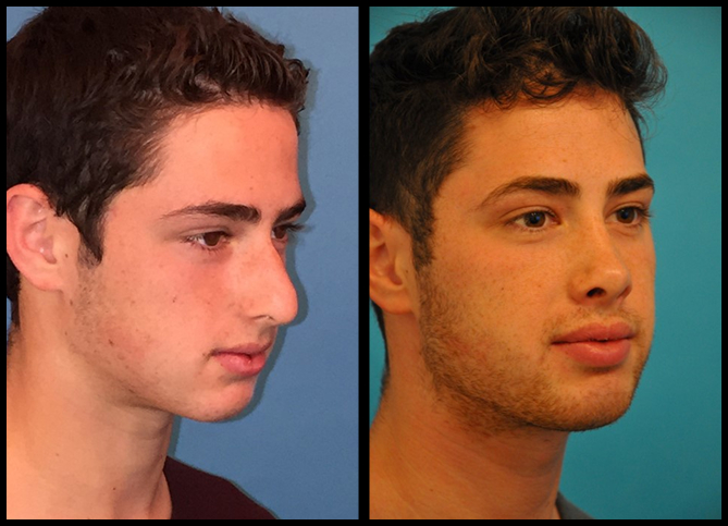 Before and After