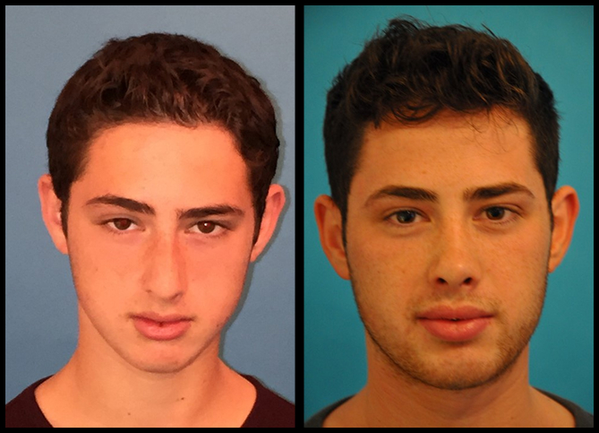 Before and After