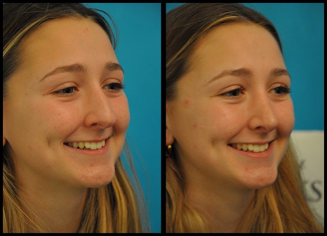 Before and After