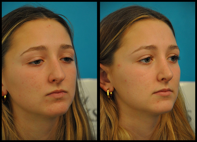 Before and After