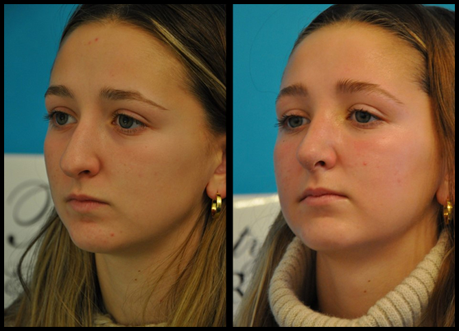 Before and After