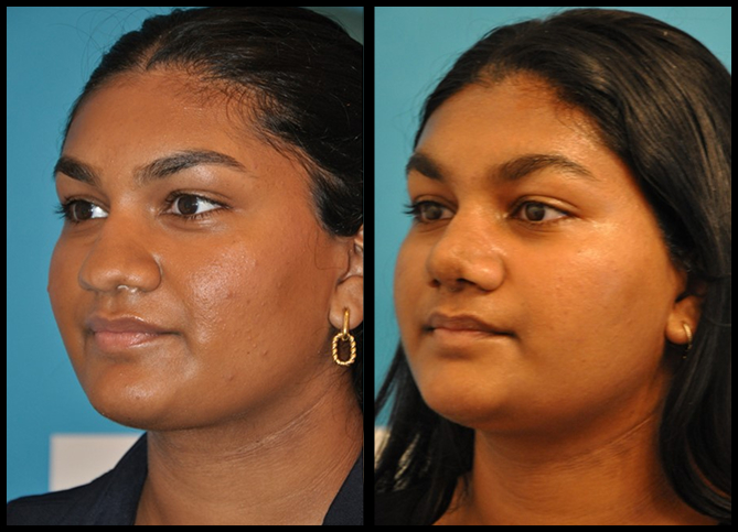 Before and After