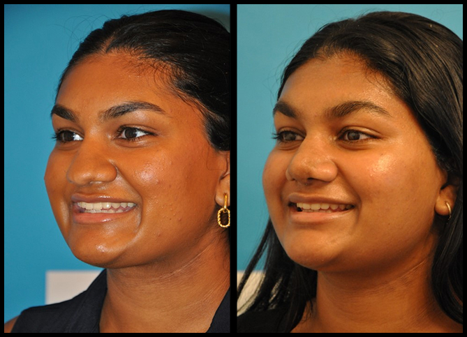 Before and After
