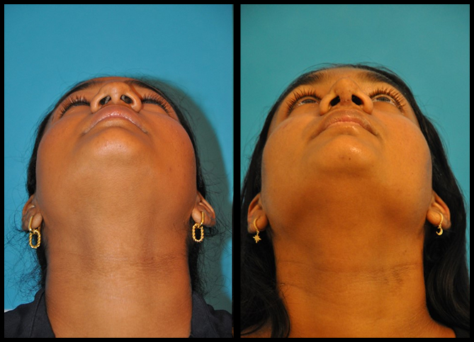 Before and After