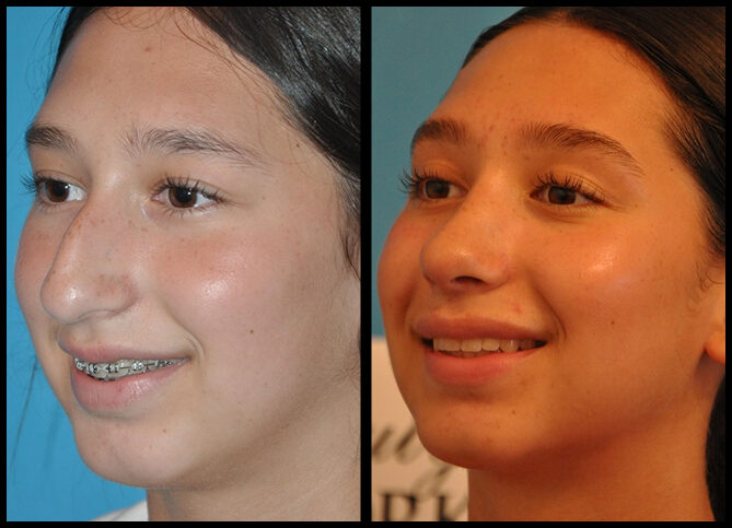Before and After