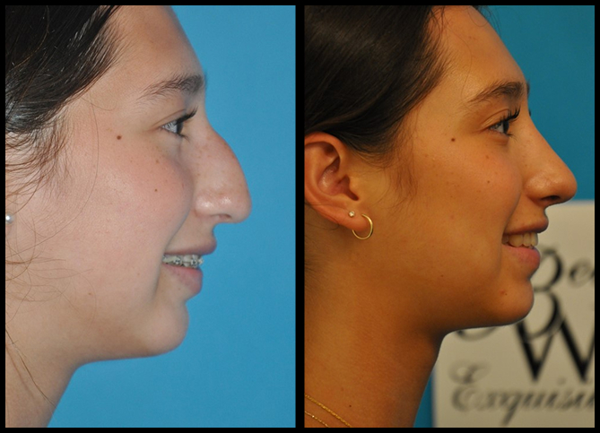 Before and After