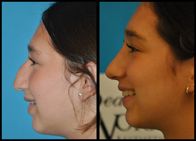 Before and After