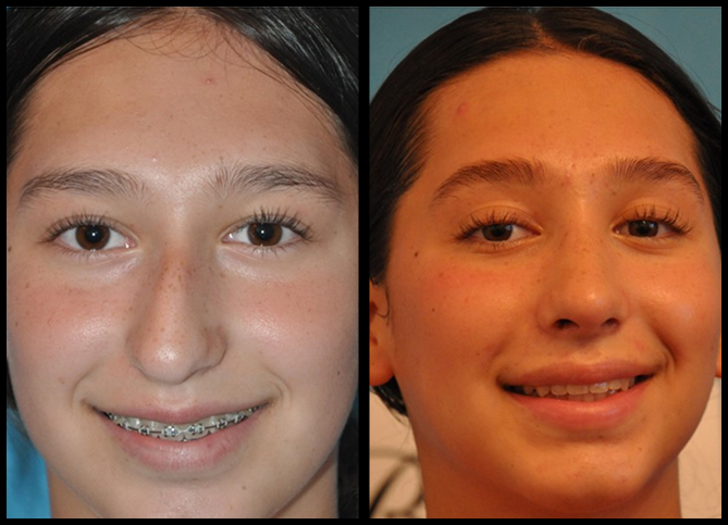 Before and After