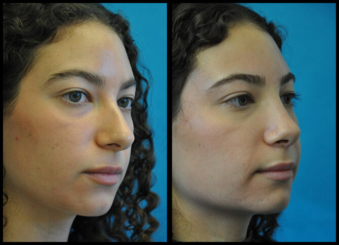 Before and After