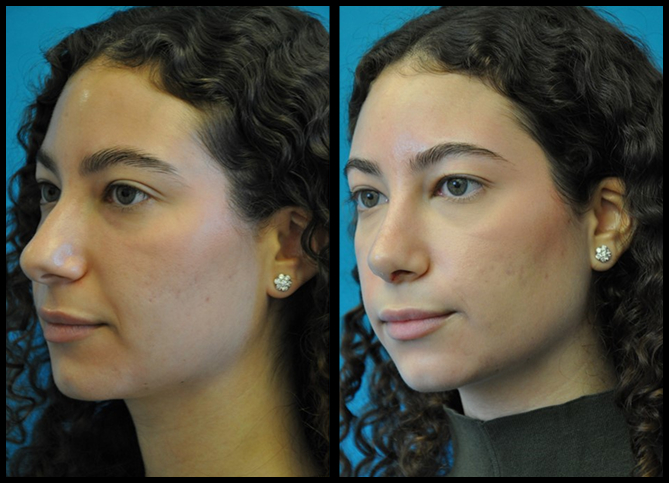 Before and After