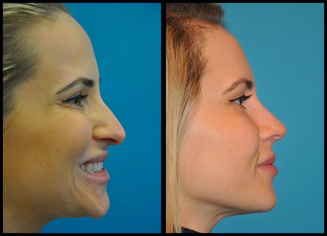 Before and After
