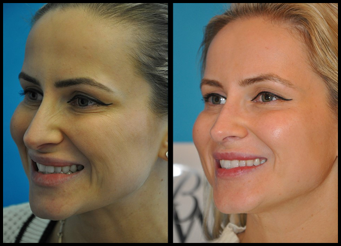 Before and After